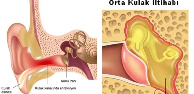 Çocuklarda Orta Kulak Enfeksiyonu   İşitme Kaybına Neden Olabilir!